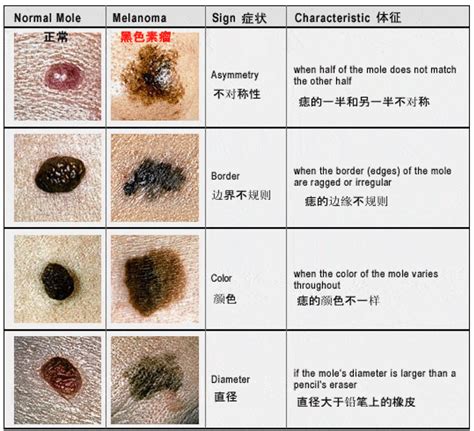 左手掌突然长痣|痣也可能会癌变！长在 3 个地方要注意